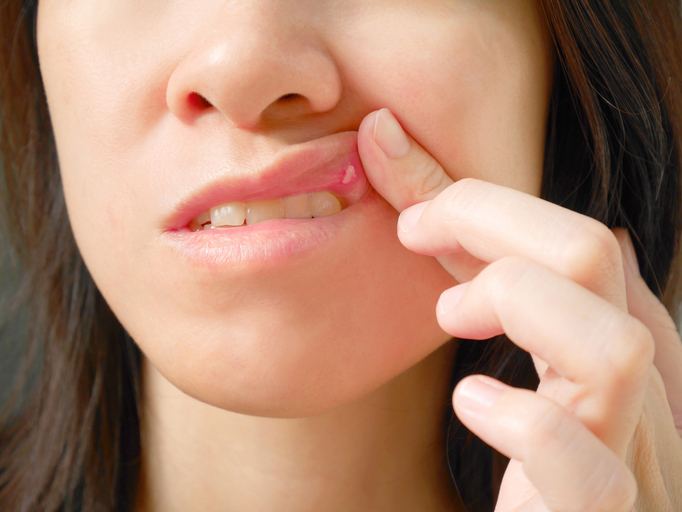 Nicotine Gum vs Lozenge